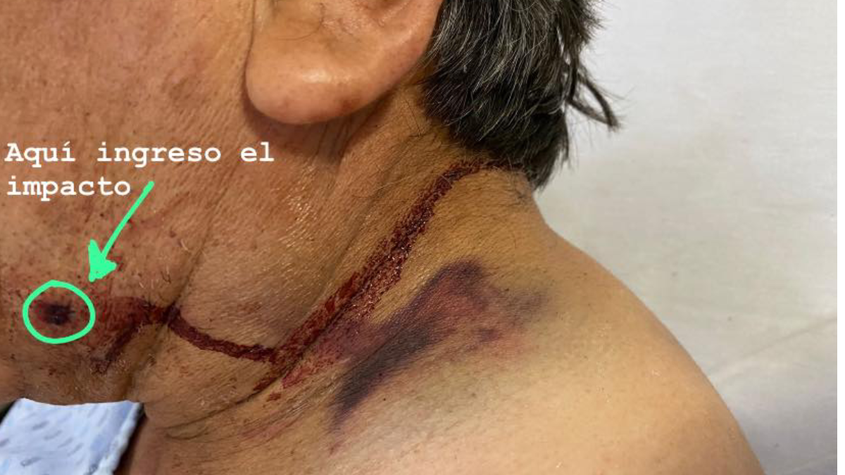 Padre de alcalde de Ozumba queda herido por resistirse a asalto